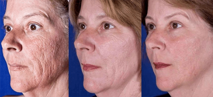 Résultat après le rajeunissement de la peau du visage au laser