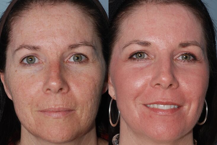 avant et après le rajeunissement de la peau