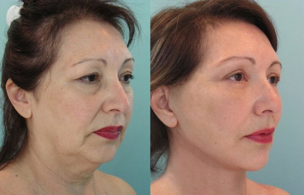 Photo avant et après rajeunissement de la peau